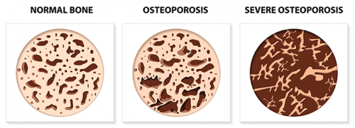 Osteoporosis detection